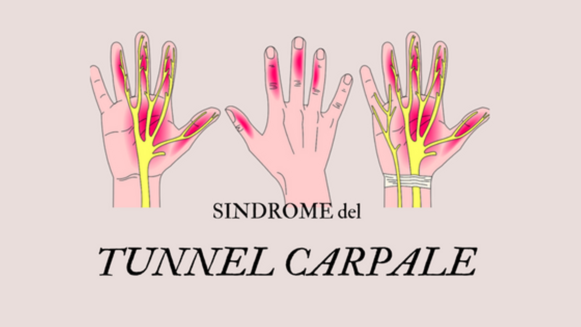 Sindrome del Tunnel Carpale Dott.ssa Caterina Gruosso Sindrome del Tunnel Carpale Dott.ssa Caterina Gruosso
